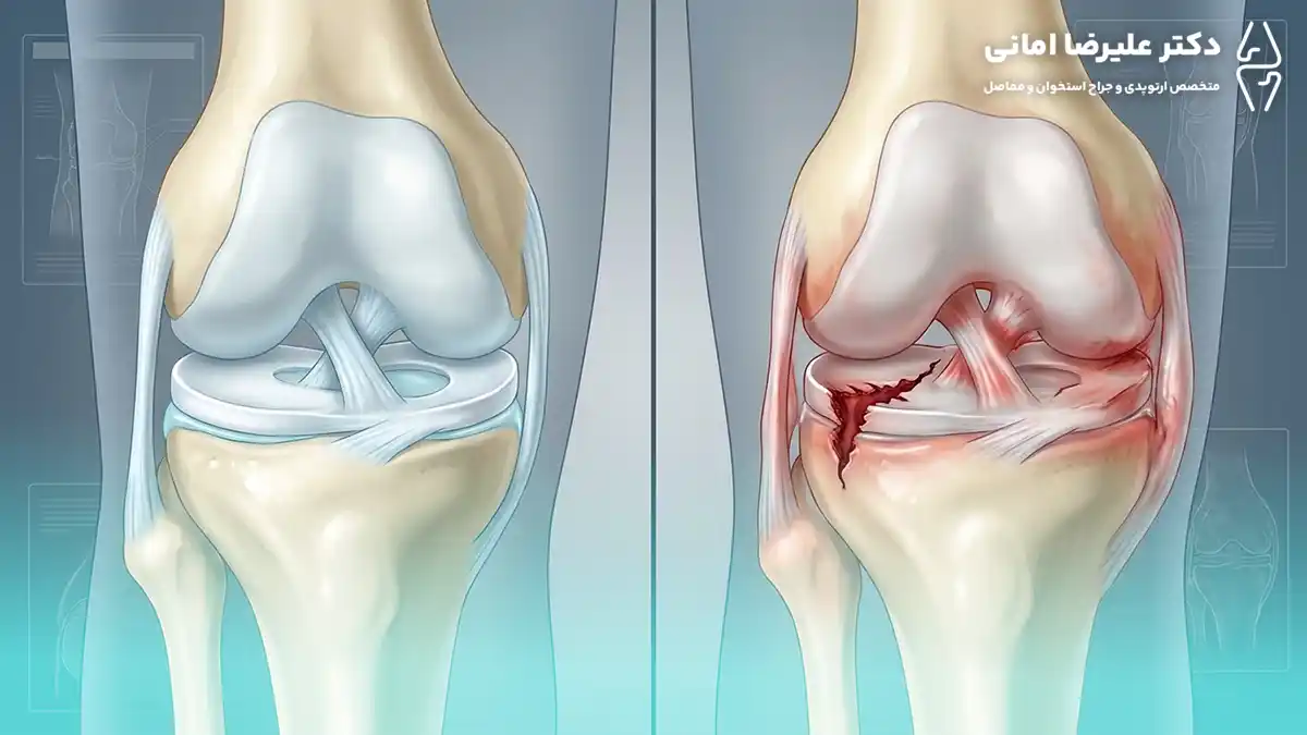 آیا پارگی مینیسک همان آسیب مینیسک است؟