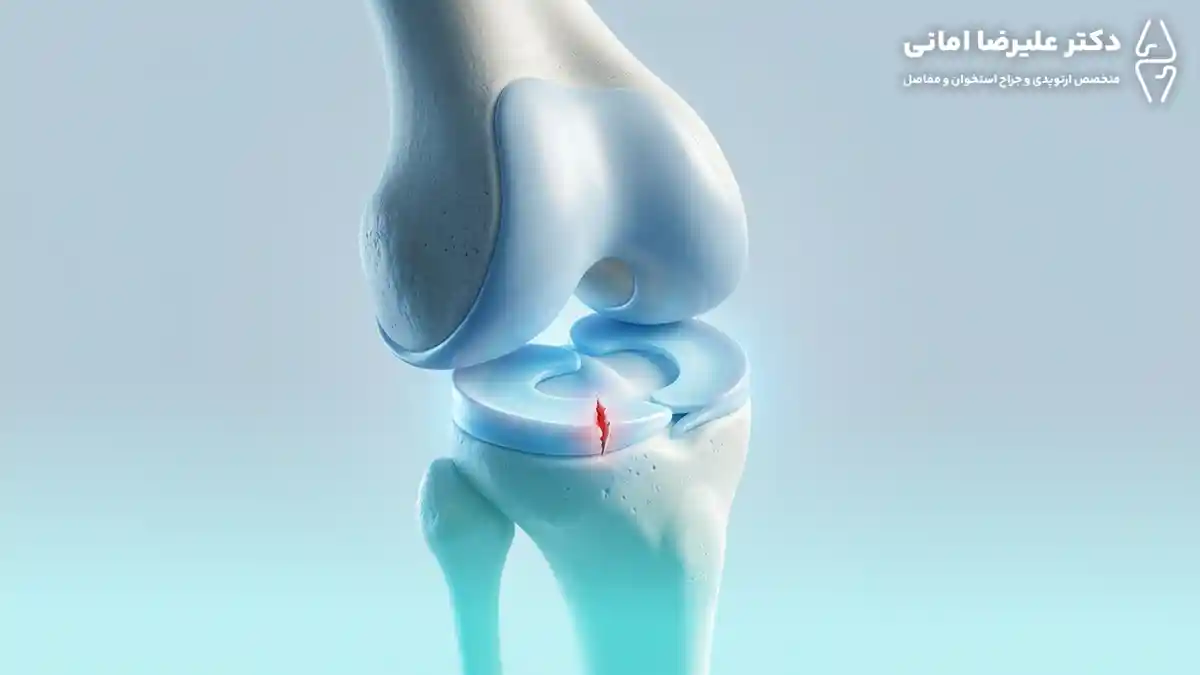 پارگی مینیسک زانو چیست؟ هر آنچه باید درباره این آسیب شایع زانو بدانید