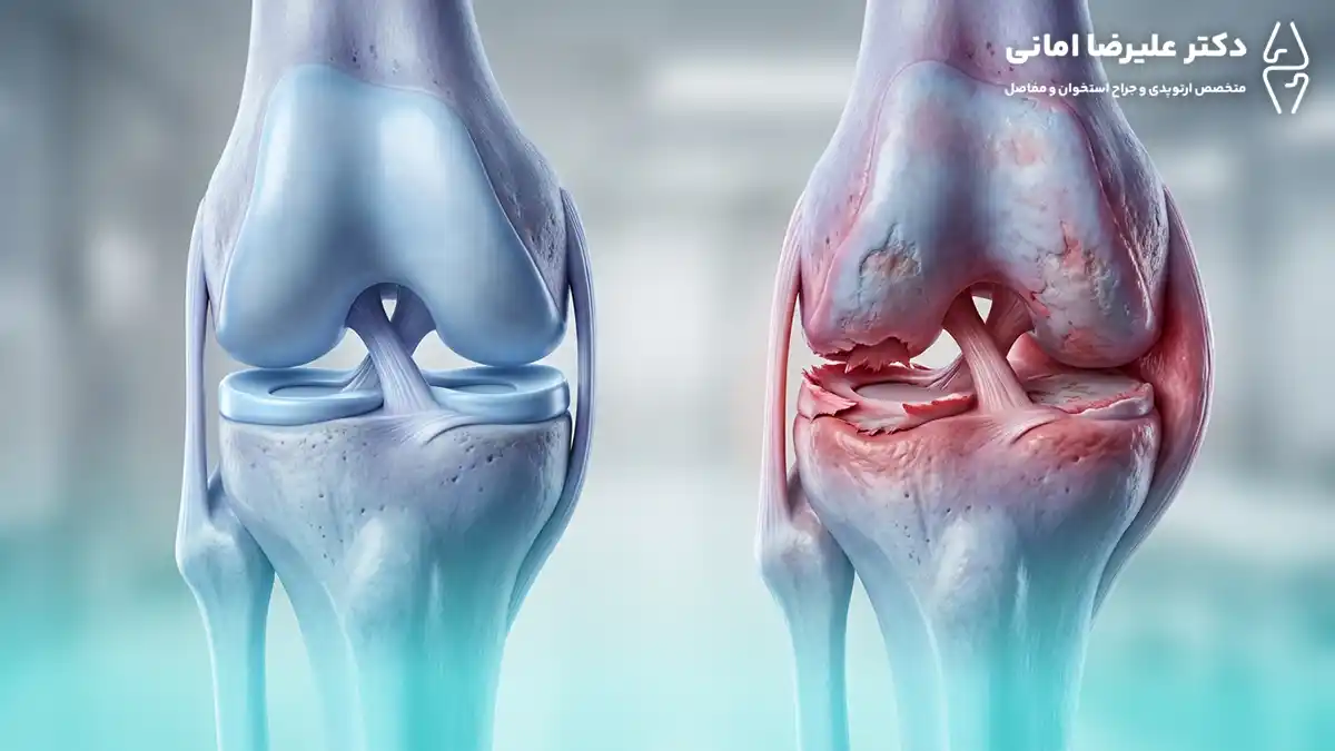 عوارض پارگی مینیسک زانو چیست؟ اگر درمان نشود چه مشکلاتی ایجاد می‌کند؟
