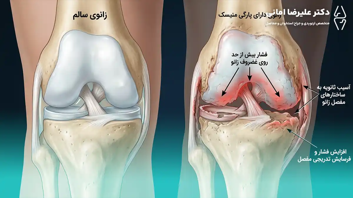 آسیب غضروف زانو در اثر پارگی مینیسک درمان‌نشده
