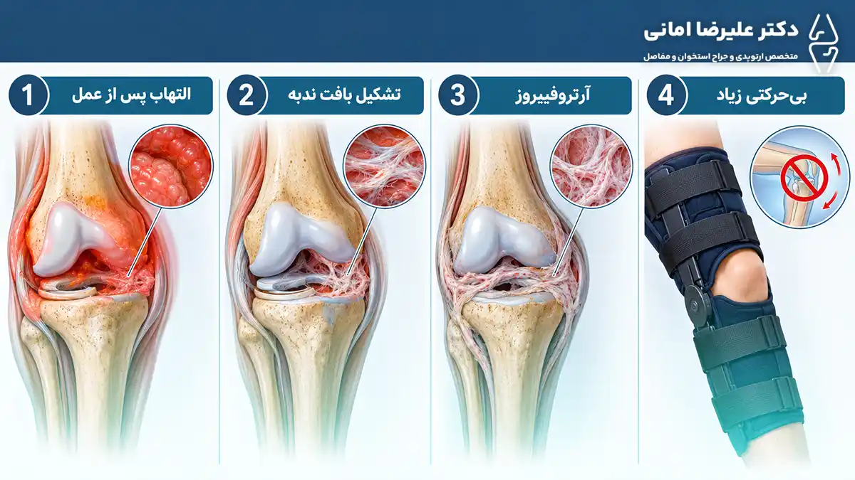 خشکی زانو بعد از مینیسکتومی